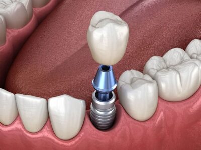 Răng sứ trên Implant bị vỡ - Nguyên nhân và cách chữa hiệu quả