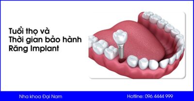 Tuổi thọ răng implant là bao lâu? | Bảo hành răng Implant vĩnh viễn tại Trung tâm Nha khoa Đại Nam