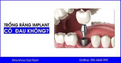 Trồng răng Implant có đau không? Cách giảm đau nhức sau khi cấy ghép Implant