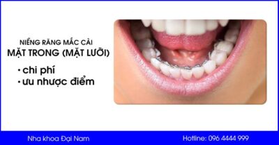 Niềng răng mắc cài mặt trong (mặt lưỡi) | ưu nhược điểm và chi phí niềng