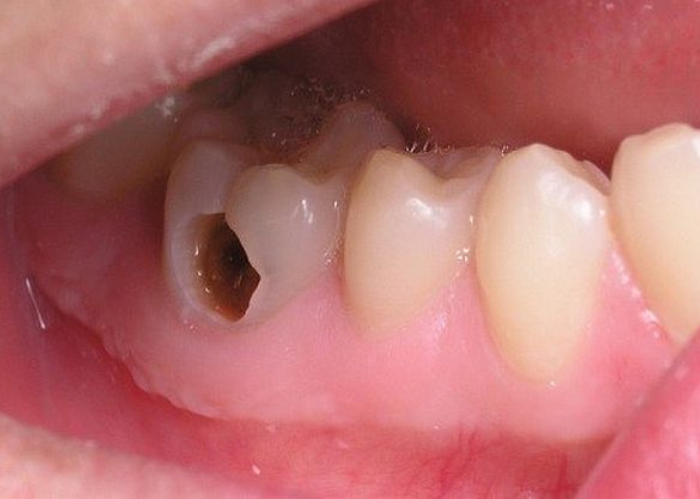 Các bệnh lý răng miệng có thể ảnh hưởng đến tuổi thọ của răng sứ kim loại