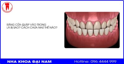 Răng cửa quặp vào trong là bị gì? Chữa răng cửa thụt vào trong như thế nào?