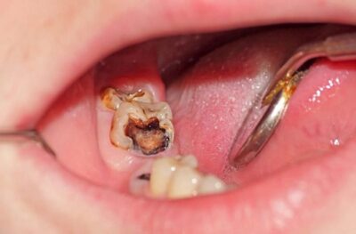 5 nguyên nhân sâu răng gây ngạc nhiên