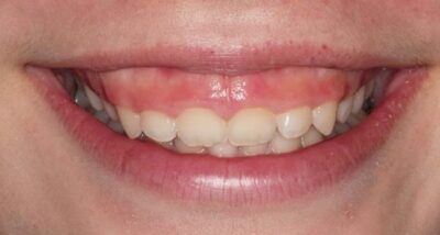 Răng ngắn - nguyên nhân tại sao và cách khắc phục hiệu quả