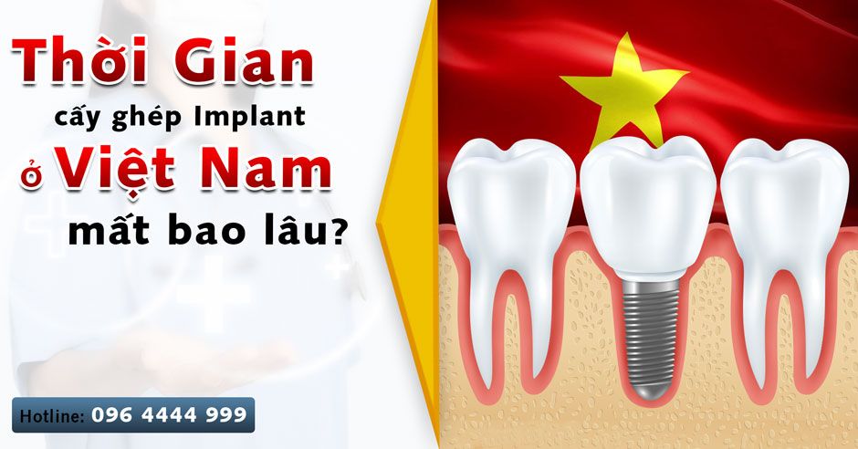 Thời gian cấy ghép implant ở Việt Nam