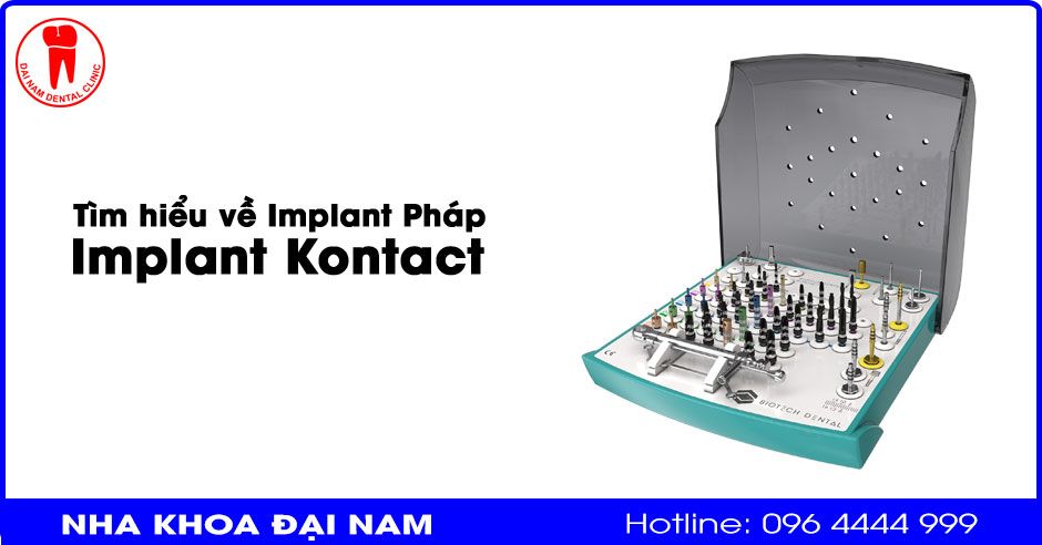 Tìm hiểu về Implant Pháp - Implant Kontact và chi phí cấy ghép